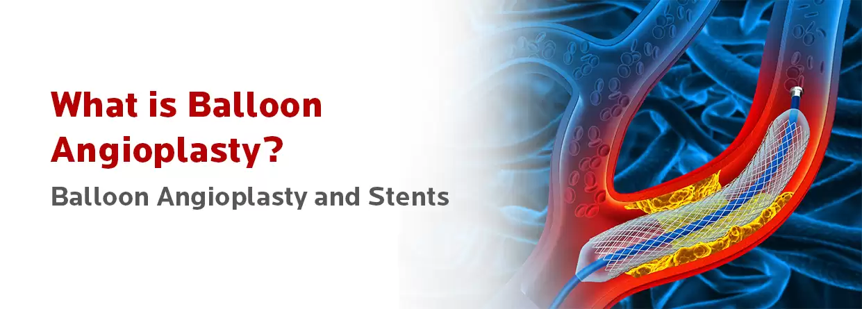 Everything You Need to Know About Balloon Angioplasty